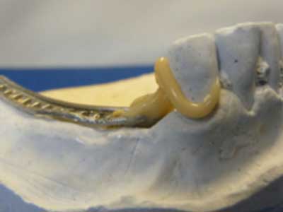 Dental-D-Clasps-2