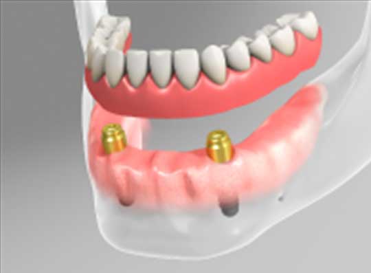 straumann-implants-1