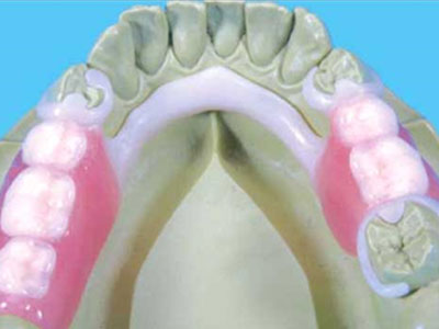 Bio-Dentaplast-Frame-Dentures
