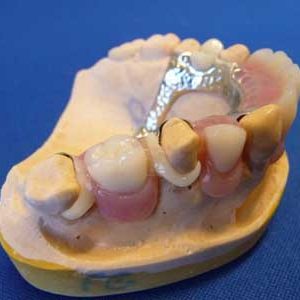 Dental-D-Clasps-1