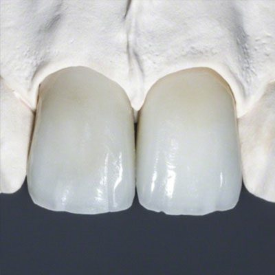 Zirconia-Crown