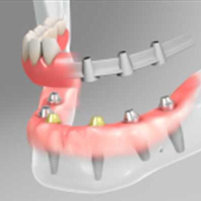 straumann-implants-2