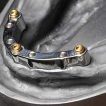 straumann-implants-5