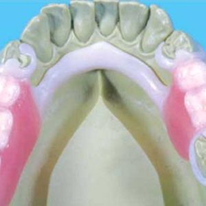 Bio-Dentaplast-Frame-Dentures